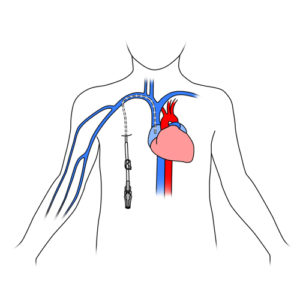 Parenteral nutrition - Complex care at home for children