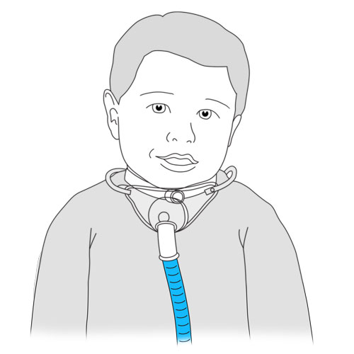 531.tracheal collar.FINAL